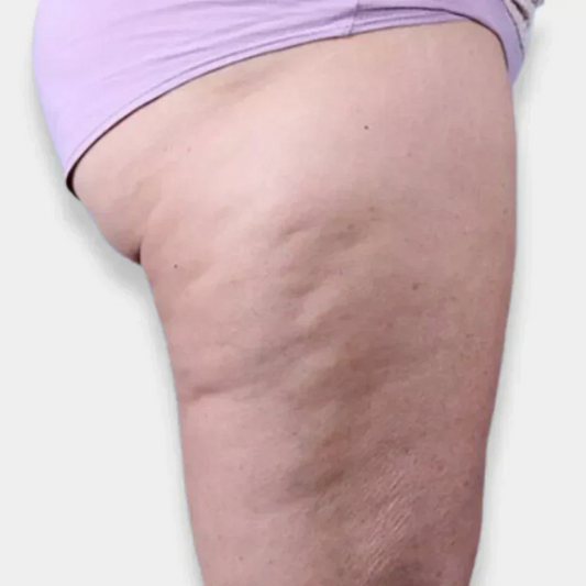How to Effectively Fight Cellulite?